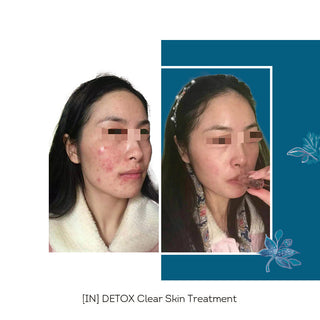 FLORÊVE [IN] DETOX Clear Skin Cure